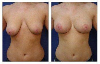 Breast Lift With Implant Augmentation Beverly Hills, CPSI, width: 350px; height: 225px; Breast Lift With Implant Augmentation Beverly Hills, CPSI, width: 350px; height: 225px;