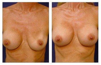 breast-augmentation-revision-patient-8-front(1) breast-augmentation-revision-patient-8-front(1)