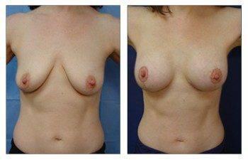 When Is A Breast Lift Covered By Insurance, CPSI. When Is A Breast Lift Covered By Insurance, CPSI.