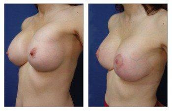 breast-augmentation-revision-patient-6-front-left breast-augmentation-revision-patient-6-front-left