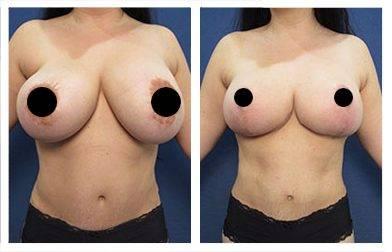 A woman's breasts undergo a remarkable transformation through the best breast lift revision procedure. A woman's breasts undergo a remarkable transformation through the best breast lift revision procedure.