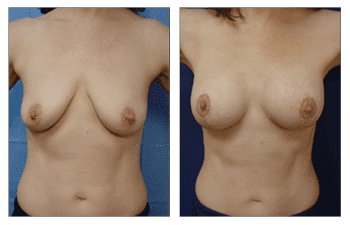 Breast Lift With Implant Augmentation Southern Los Angeles; CPSI, width: 350px; height: 225px; Breast Lift With Implant Augmentation Southern Los Angeles; CPSI, width: 350px; height: 225px;