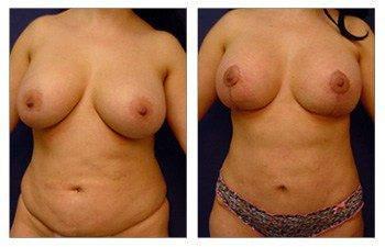 breast-lift-with-implant-augmentation-patient-11-front(1) breast-lift-with-implant-augmentation-patient-11-front(1)