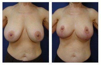 Breast Lift With Implant Augmentation To Decrease Areola Size, CPSI, width: 350px; height: 225px; Breast Lift With Implant Augmentation To Decrease Areola Size, CPSI, width: 350px; height: 225px;