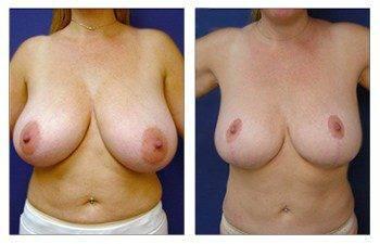 How Does Breast Lift work, CPSI. How Does Breast Lift work, CPSI.