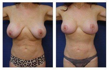breast augmentation revision recovery patient 9 front view breast augmentation revision recovery patient 9 front view