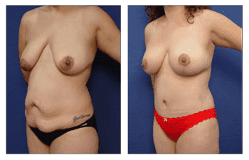 orange county mommy makeover newport beach patient 24 front left orange county mommy makeover newport beach patient 24 front left