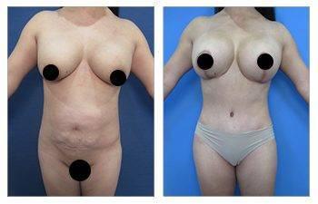 Breast Implant Removal Surgery Breast Implant Removal Surgery