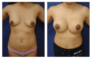 Breast Lift With Implant Augmentation Southern California; CPSI, width: 350px; height: 225px; Breast Lift With Implant Augmentation Southern California; CPSI, width: 350px; height: 225px;