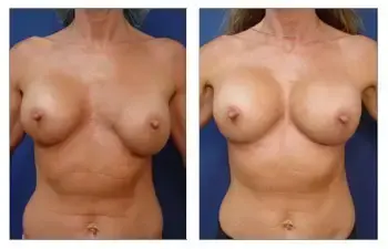 A woman's breasts before and after breast augmentation surgery. A woman's breasts before and after breast augmentation surgery.
