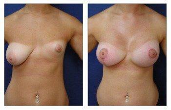 breast-lift-with-implant-augmentation-patient-17-front(1) breast-lift-with-implant-augmentation-patient-17-front(1)