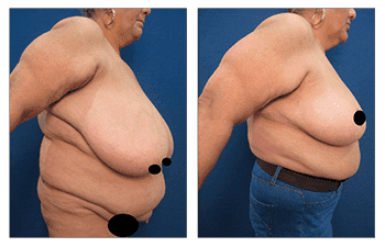 Before and after pictures of a woman who underwent HD Liposuction on her large breasts. Before and after pictures of a woman who underwent HD Liposuction on her large breasts.