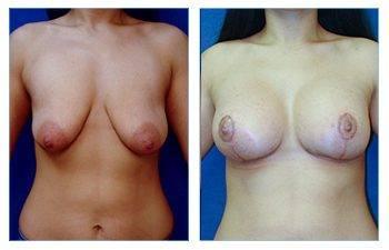 Breast Lift with Implant to Correct Breast Sagging Breast Lift with Implant to Correct Breast Sagging
