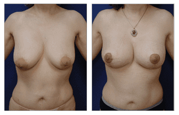 Breast Lift With Implant Augmentation Southern Orange County; CPSI, width: 350px; height: 225px; Breast Lift With Implant Augmentation Southern Orange County; CPSI, width: 350px; height: 225px;