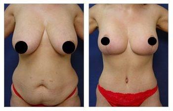 Mommy Makeover Near Me Mommy Makeover Near Me