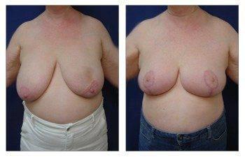 Where Are Breast Lift Scars, CPSI, width: 350px; height: 225px; Where Are Breast Lift Scars, CPSI, width: 350px; height: 225px;