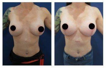 A woman's breast before and after surgery to fix breast herniation. A woman's breast before and after surgery to fix breast herniation.