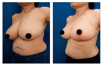 A woman's breast before and after Breast Augmentation surgery. A woman's breast before and after Breast Augmentation surgery.