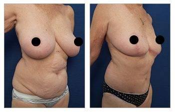 A woman's transformation through breast augmentation, showcasing her tattoos before and after the procedure. A woman's transformation through breast augmentation, showcasing her tattoos before and after the procedure.