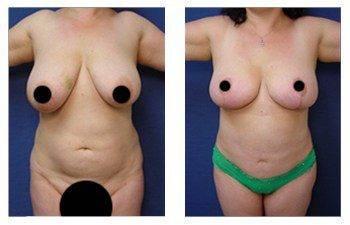 Which breast lift do I need, CPSI, width: 350px; height: 225px; Which breast lift do I need, CPSI, width: 350px; height: 225px;