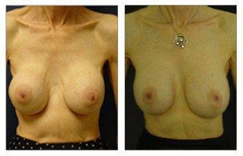 breast-augmentation-revision-patient-12-front(1) breast-augmentation-revision-patient-12-front(1)