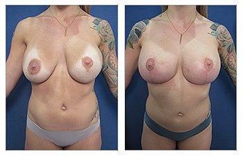 Breast Implant Brands Breast Implant Brands