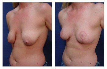 Is Breast Lift Safe, CPSI, width: 350px; height: 225px; Is Breast Lift Safe, CPSI, width: 350px; height: 225px;