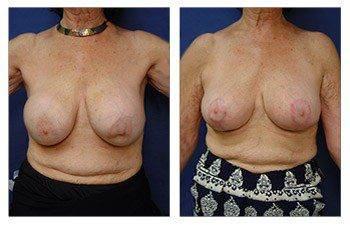 breast-augmentation-revision-patient-23-front(1) breast-augmentation-revision-patient-23-front(1)