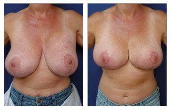 Breast Lift With Implant Augmentation To Correct Breast Deformity, CPSI, width: 350px; height: 225px; Breast Lift With Implant Augmentation To Correct Breast Deformity, CPSI, width: 350px; height: 225px;