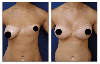 A woman's breast before and after corrective breast augmentation for congenital deformity. A woman's breast before and after corrective breast augmentation for congenital deformity.