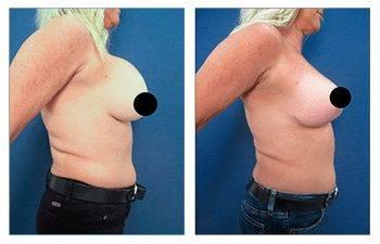 A woman's breast before and after surgery to remove stretch marks. A woman's breast before and after surgery to remove stretch marks.