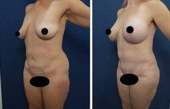 Before and after pictures showcasing a woman's remarkable buttlift transformation. Before and after pictures showcasing a woman's remarkable buttlift transformation.