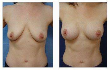 Breast Lift With Implant Augmentation Southern Los Angeles; CPSI, width: 350px; height: 225px; Breast Lift With Implant Augmentation Southern Los Angeles; CPSI, width: 350px; height: 225px;