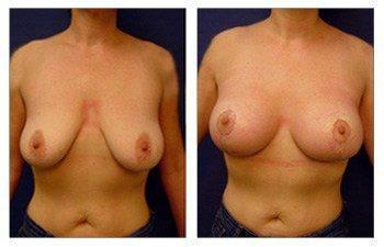 breast-lift-with-implant-augmentation-patient-8-front breast-lift-with-implant-augmentation-patient-8-front