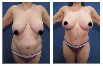 Mini tummy tuck before and after results. Mini tummy tuck before and after results.