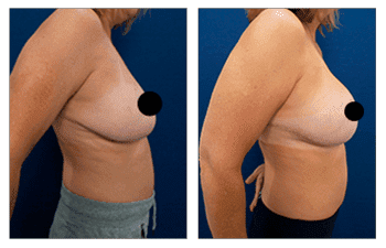 A woman's breast before and after Breast Augmentation surgery. A woman's breast before and after Breast Augmentation surgery.