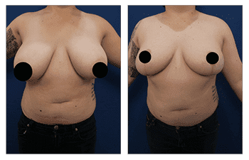 Breast Lift Surgery Breast Lift Surgery