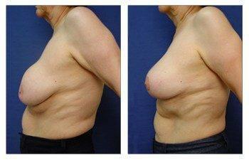 breast-augmentation-revision-patient-3-left(1) breast-augmentation-revision-patient-3-left(1)