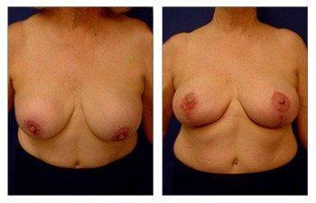 breast-lift-with-implant-augmentation-patient-9-front(1) breast-lift-with-implant-augmentation-patient-9-front(1)
