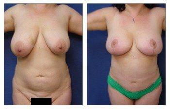 Which breast lift do I need, CPSI, width: 350px; height: 225px; Which breast lift do I need, CPSI, width: 350px; height: 225px;