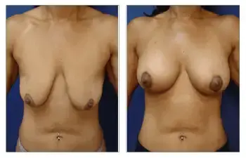 A woman's breasts before and after Breast Lift surgery. A woman's breasts before and after Breast Lift surgery.