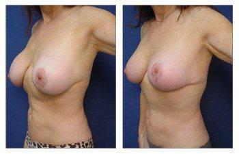 breast augmentation revision recovery patient 9 front left view breast augmentation revision recovery patient 9 front left view