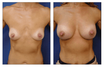 Breast Augmentation Orange County Breast Augmentation Orange County