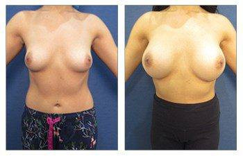 Breast Augmentation Surgeon Results Breast Augmentation Surgeon Results