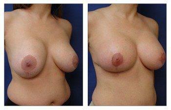 breast augmentation smaller patient 16 front right view breast augmentation smaller patient 16 front right view