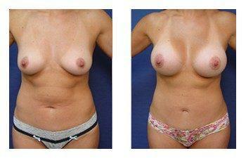Breast Augmentation — #SS197 Breast Augmentation — #SS197
