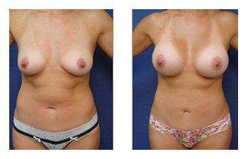 Breast Augmentation — #SS197 Breast Augmentation — #SS197