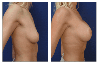 Best Breast Augmentation Surgeon, CPSI, width: 350px; height: 225px; Best Breast Augmentation Surgeon, CPSI, width: 350px; height: 225px;