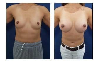 Breast Implant Surgery Breast Implant Surgery