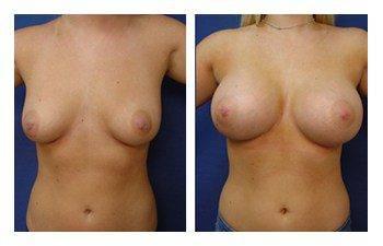 Breast Augmentation to Go Bigger, CPSI, width: 350px; height: 225px; Breast Augmentation to Go Bigger, CPSI, width: 350px; height: 225px;